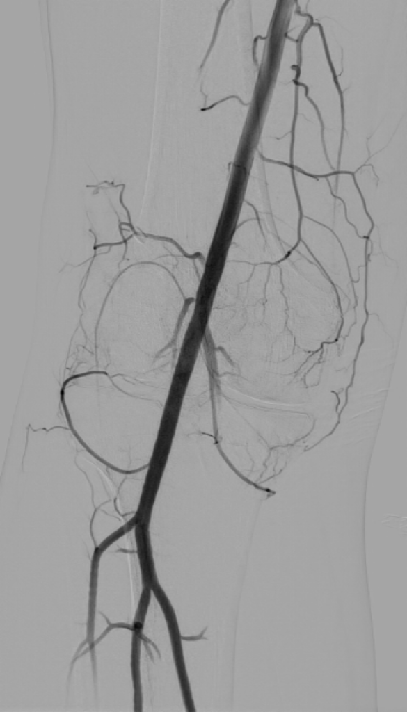 Artériographie fémorale superficielle