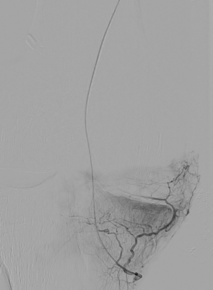 Artériographie supra sélective de l'artère géniculée inféro-médiale