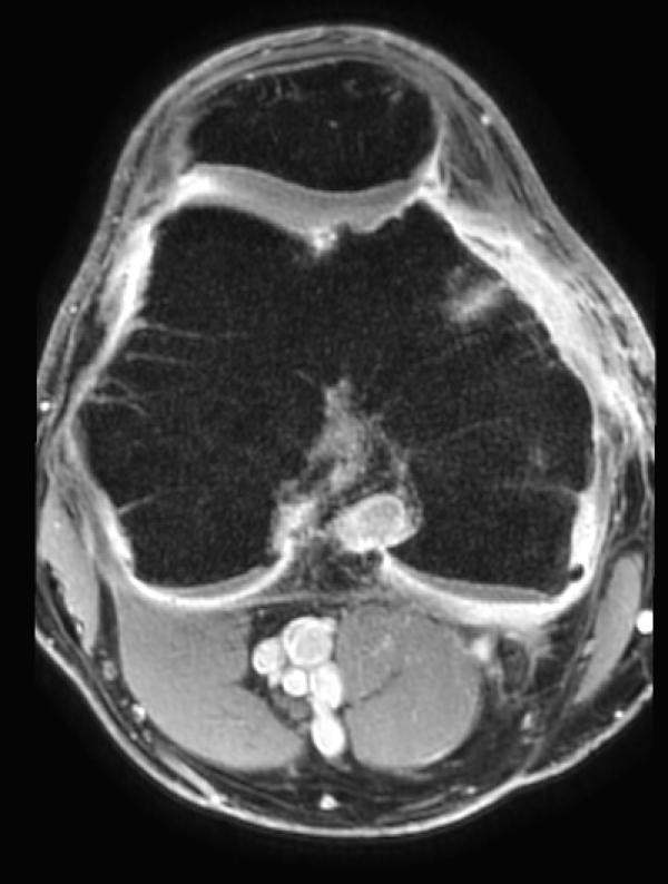 IRM du genou avec injection