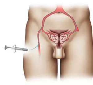 Schéma voie fémorale