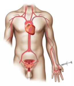 Schéma voie radiale gauche
