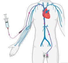 Varicocele embolisation