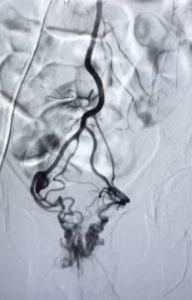 Bilan artères rectales supérieures avant embolisation