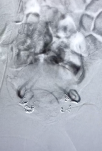 Contrôle artères rectales supérieures après embolisation