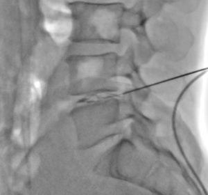 Scopie de profil infiltration intra discale