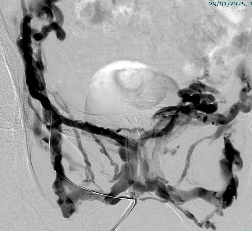 Angiographie de bilan par voie veineuse du petit bassin