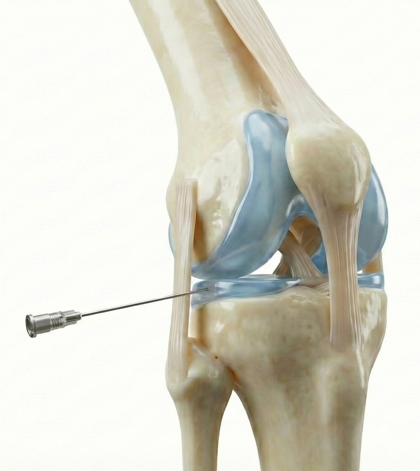 Radiofréquence genou - Genou