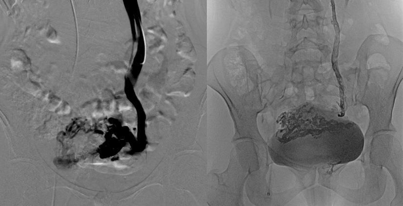 Phlébographie de la veine ovarienne gauche – Embolisation à la colle biologique