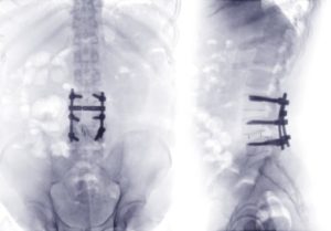 Arthrodèse lombaire