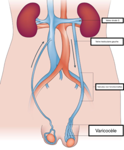 circulation varicocèle